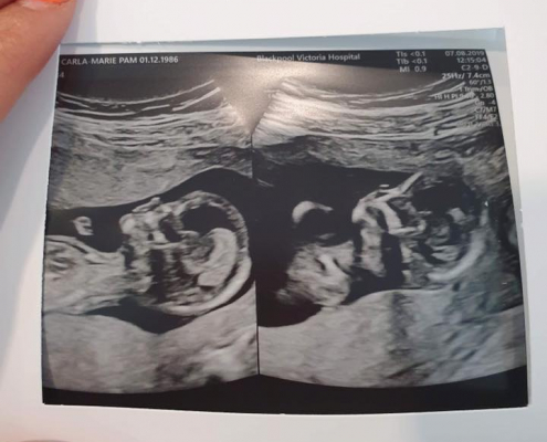 Monoamniotic-Monochorionic (MoMo) Twins - My Twin Loss Story