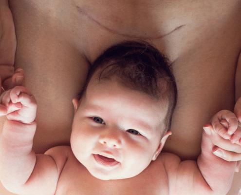 Cesarean Section - Recovery - Everything You Need to Know