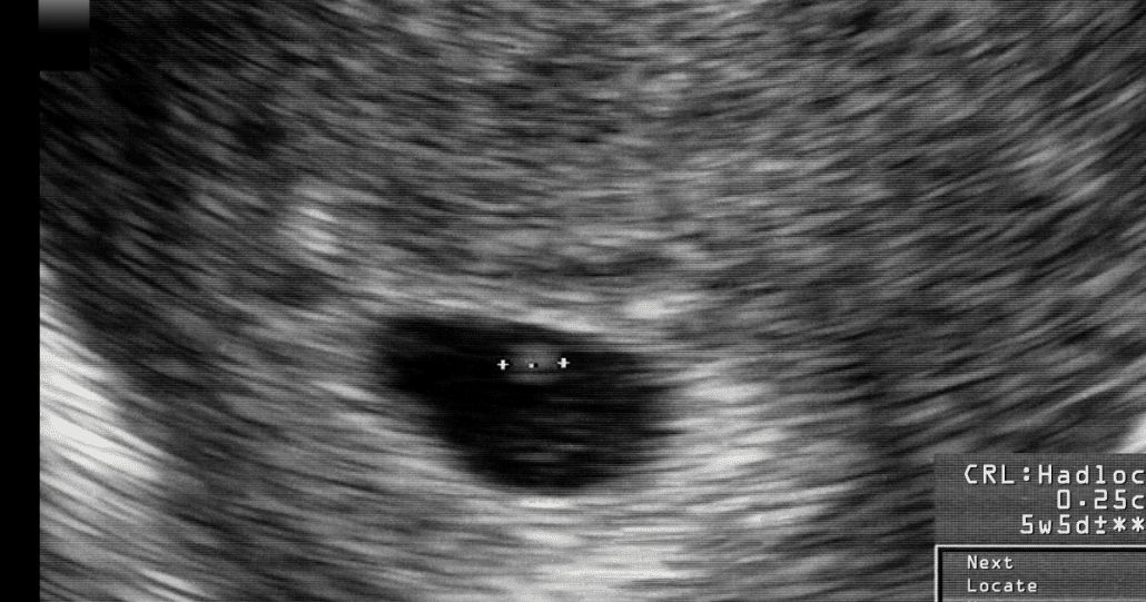 Pregnant Ultrasound