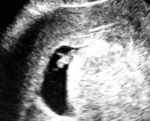 6 week ultrasound