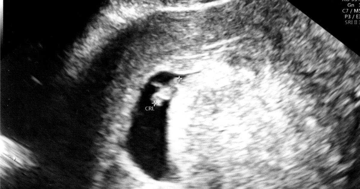 6 Week Ultrasound Scan - Everything You Need to Know - MyBump2Baby