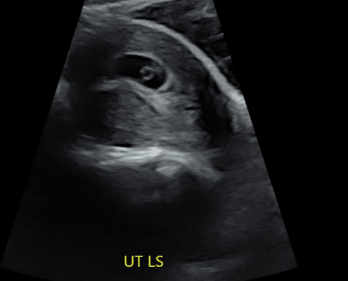 7 week ultrasound