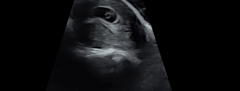 7 week ultrasound