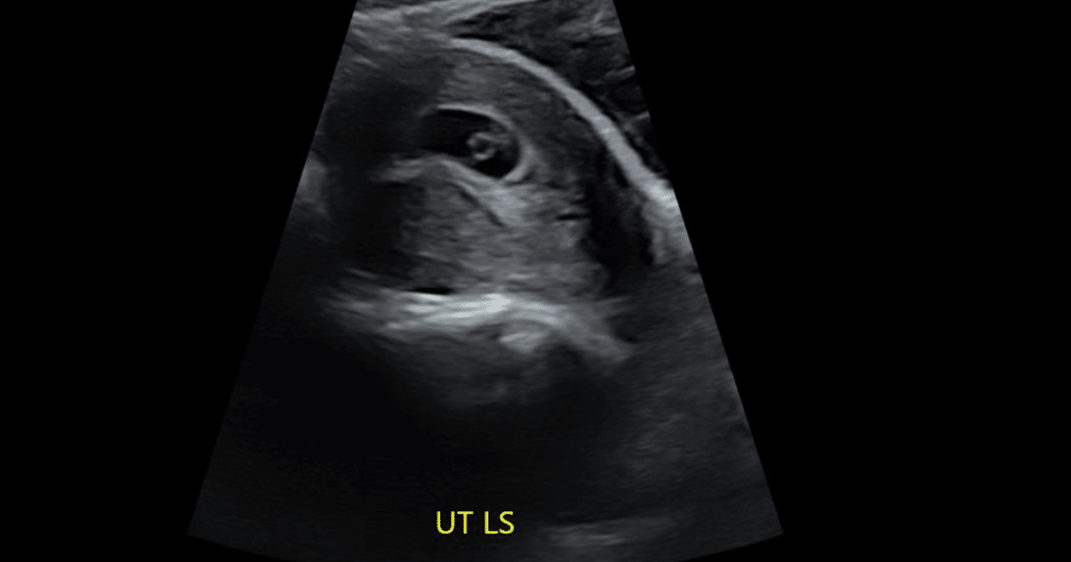 7 Week Ultrasound - Everything you NEED to know - MyBump2Baby
