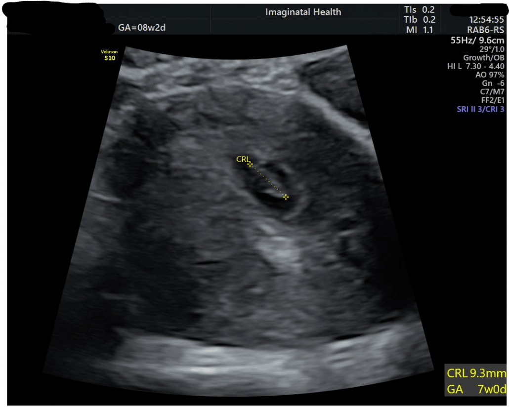 7 week ultrasound