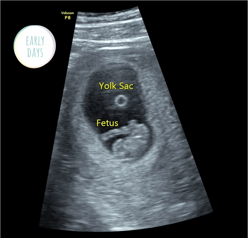 ultrasound pictures at 8 weeks