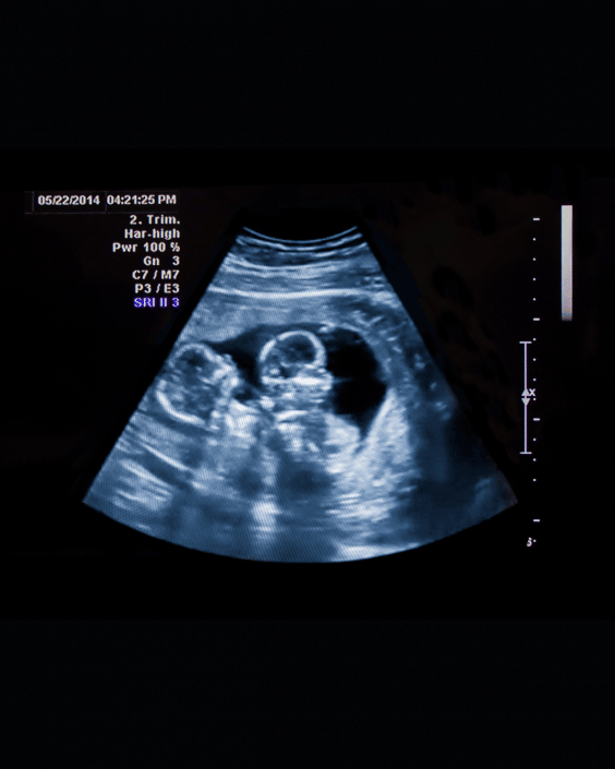 Can Twins Cause False Negative Pregnancy Test MyBump2Baby