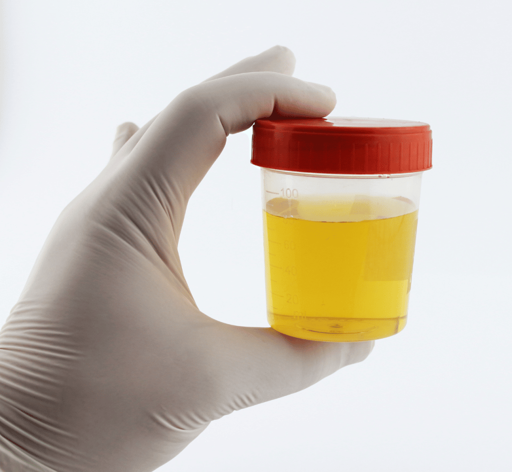 urine infection urine sample tested