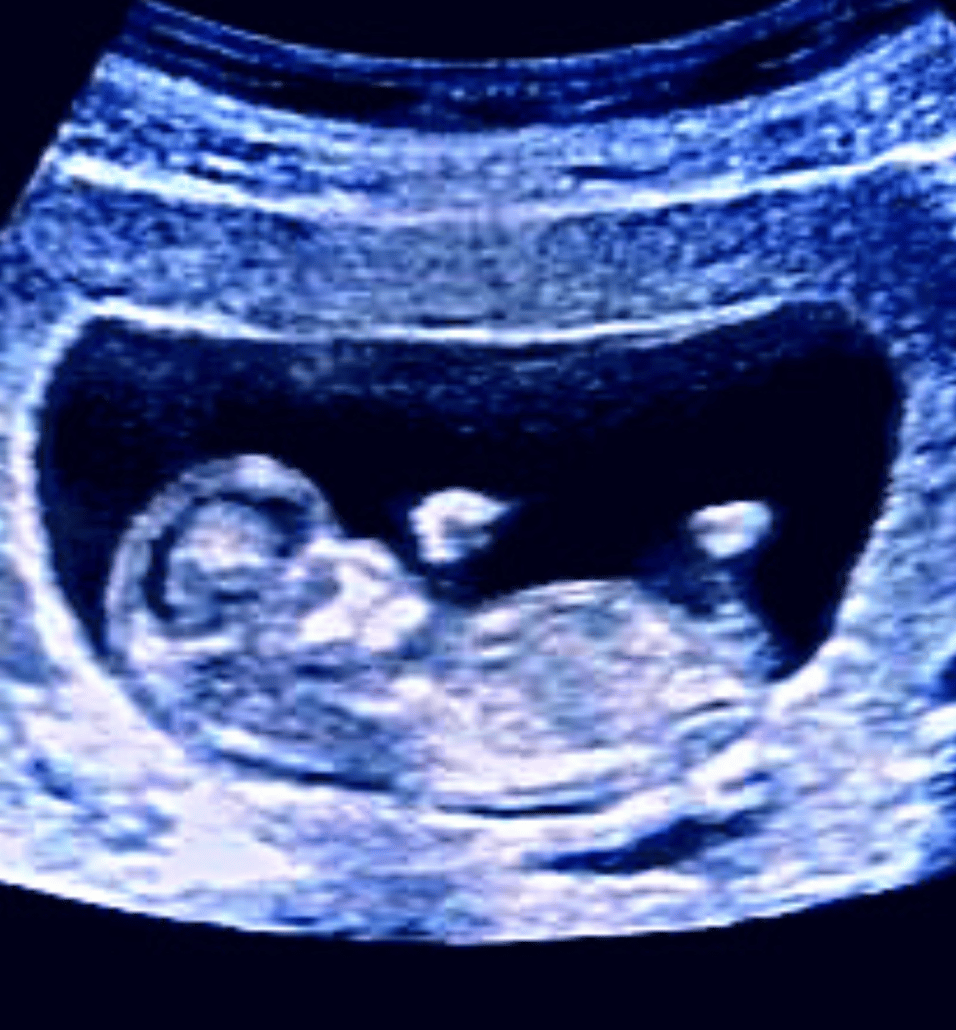 11 week ultrasound image
