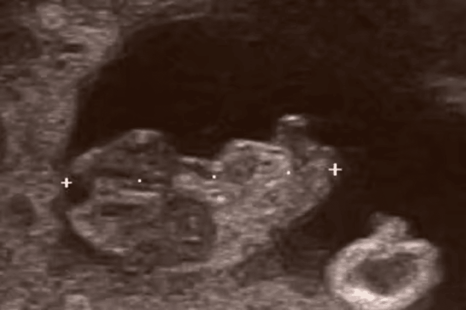 9 week ultrasound photo