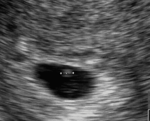 Can You Hear a Heartbeat at 5 Weeks