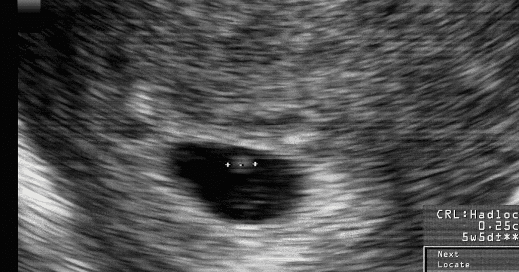 the-mclaughlin-family-15-weeks-5-days-ultrasound