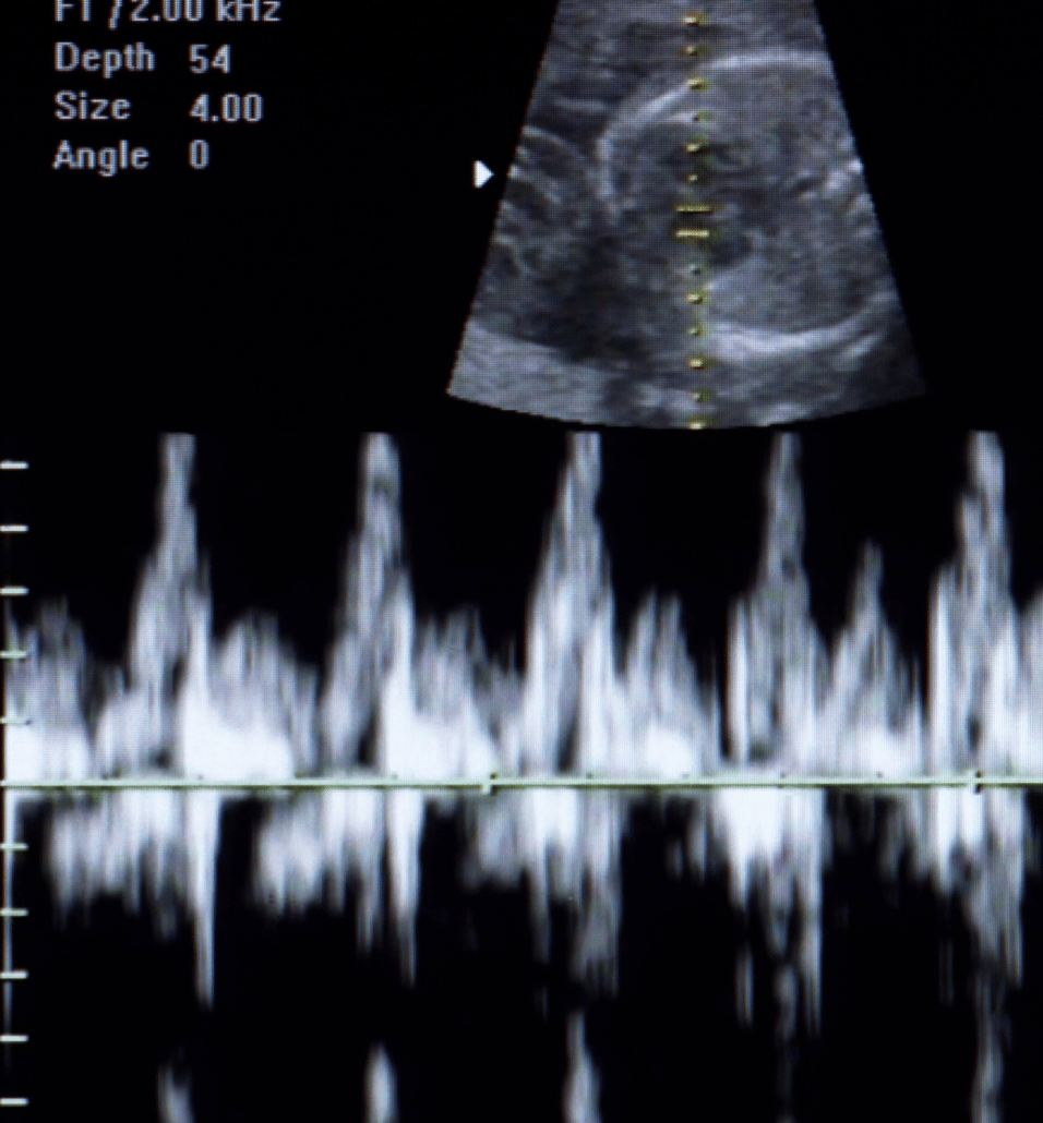 baby heartbeat