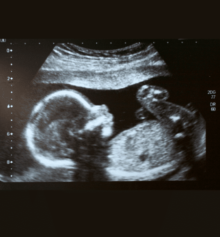 15 Week Ultrasound - What to Expect - Pregnant - MyBump2Baby