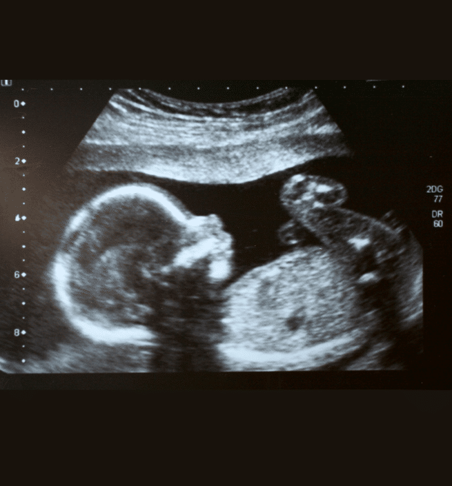 15 Week Ultrasound What To Expect Pregnant MyBump2Baby 15-week-ultrasound-what-to-expect-pregnant-mybump2baby