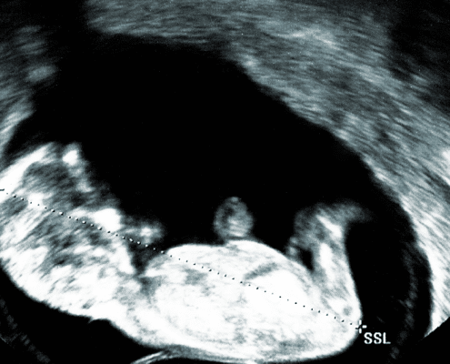 14 Week Ultrasound